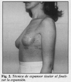 Técnica de expansor tisular