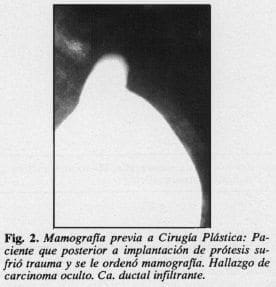 Implantación de prótesis Implantación de prótesis