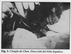 Cirugía de Chen
