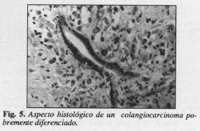 Colangiocarcinoma