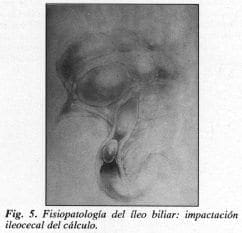 Ileocecal del cálculo