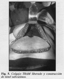 Colgajo TRAM liberado