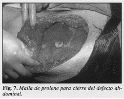 Cierre del defecto abdominal