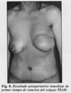 Rotacion del colgajo TRAM