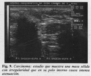 Carcinoma: polo interno causa intensa atenuación Carcinoma: polo interno causa intensa atenuación