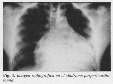 Síndrome pospericardiotomía