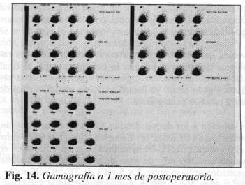 Gamagrafía a 1 mes de postoperatorio