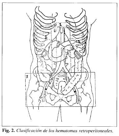 Hematomas retroperitoneales
