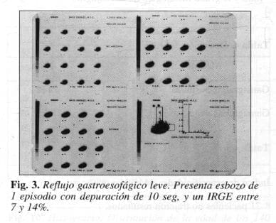 Reflujo gastroesofágico leve