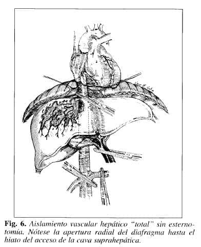 Aislamiento vascular hepático