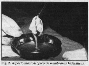 Membranas hidatídicas