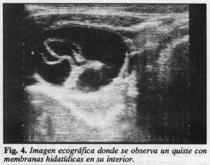 Quiste con membranas hidatídicas