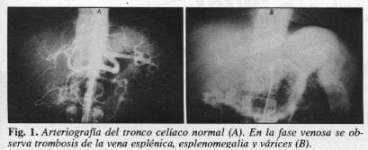 Arteriografía del tronco celíaco normal