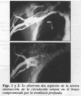 Obstrucción de la circulación venosa en el brazo
