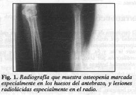 Osteopenia
