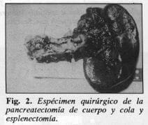 Pancreatectomía de cuerpo y cola