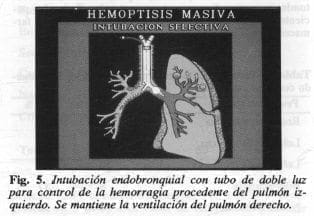 Intubación endobronquial