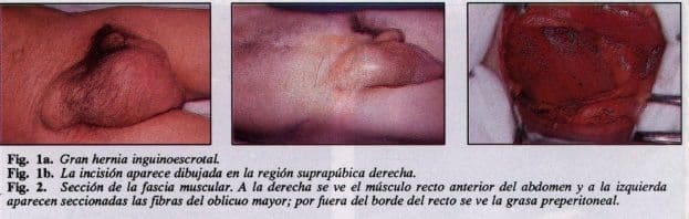 Gran hernia inguinoescrotal