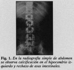 Calcificación en el hipocondrio