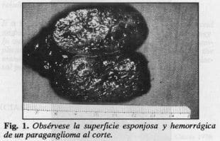 Superficie esponjosa y hemorrágica de un paraganglioma