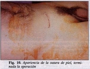 Apariencia de la sutura de piel
