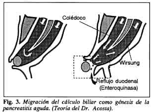 Migración del cálculo biliar