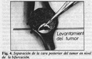 Tumor en nivel de la bifurcación