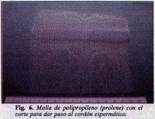 >Malla de polipropileno (prolene)