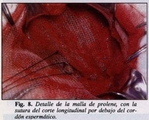 Detalle de la malla de prolene