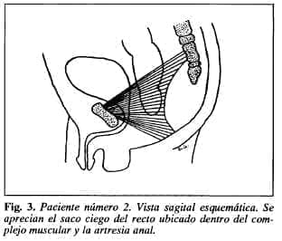 Saco ciego del recto