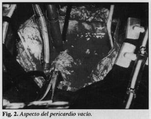 Aspecto del pericardio vacío - Trasplante Cardíaco Aspecto del pericardio vacío - Trasplante Cardíaco