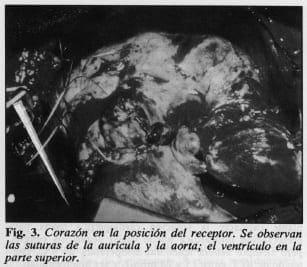 Corazón en la posición del receptor
