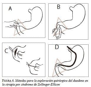 Cirugía por síndrome de Zollinger-Ellison