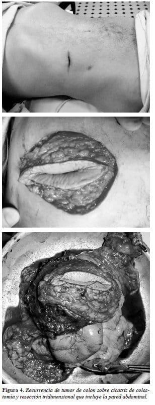 Tumor de colon sobre cicatriz de colostomía