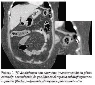 reconstrucción en plano coronal