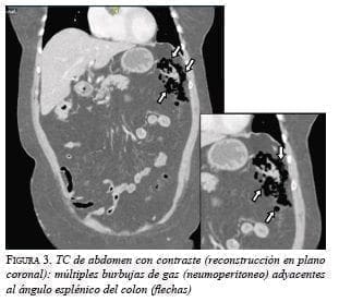 Angulo esplénico del colon