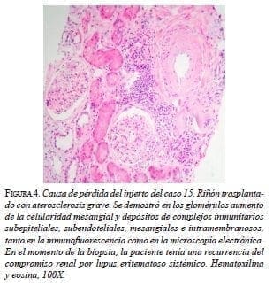 Riñón trasplantado con aterosclerosis grave