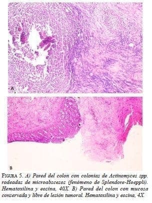 Colonias de Actinomyces