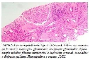 Causa de pérdida del injerto