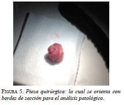 Pieza quirúrgica de Adenoma