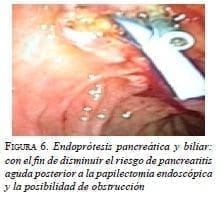Endoprótesis pancreática y biliar