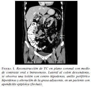 Reconstrucción de TC en plano coronal