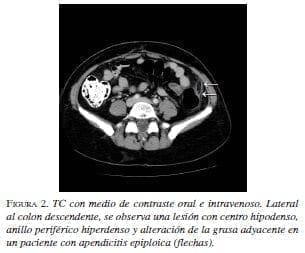 Apendicitis epiploica