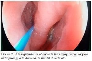 Luz Esofágica con guía hidrofílica