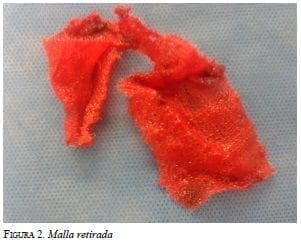 Malla
