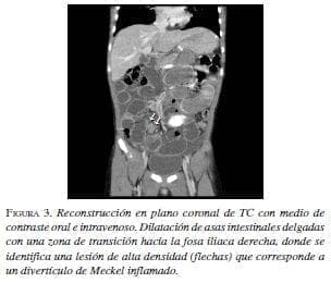Reconstrucción en plano coronal