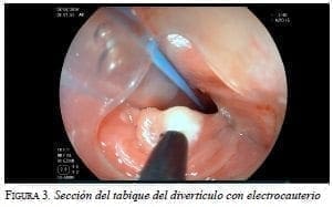 Tabique del divertículo