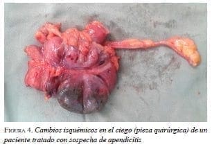 Cambios isquémicos de apendicitis