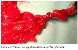 Torsión del epiplón