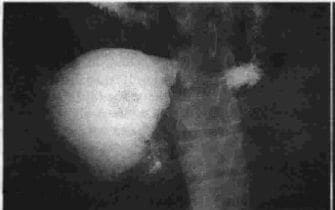 Estenosis boca anastomótica